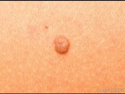 Remove Skin Tags